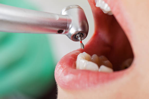 Best Emergency Tooth Extraction in Cordova, AL